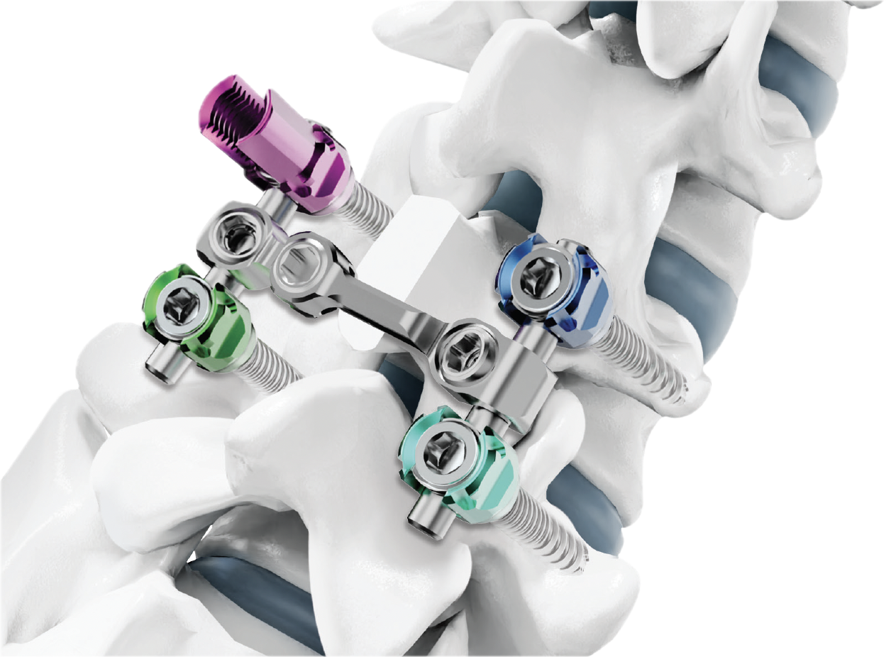 ANAX 5.5 — Tornillo poliaxial abierto