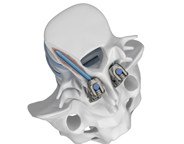 ANAX CT — Tornillo de trayectoria cortical