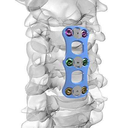 ASPIRON™ — Placa cervical anterior