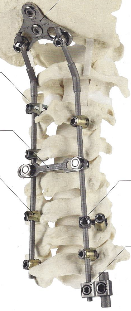 PRIMA — Tornillo poliaxial cervical posterior